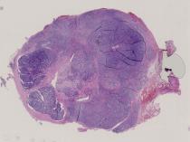 vignette Lame virtuelle : Parotide : Cas n°1 - tumeur maligne - carcinome adénoïde kyste
