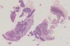 vignette Lame virtuelle : Parotide : Cas n°3 - tumeur maligne - carcinome sécrétoire des glandes salivaires de type mammaire (MASC)