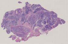vignette Lame virtuelle : Parotide : Cas n°4 - tumeur maligne - carcinome des canaux salivaires 