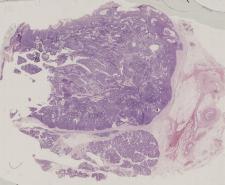 vignette Lame virtuelle : Parotide : Cas n°5 - tumeur maligne - carcinome à cellules acineuses