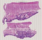 vignette Lame virtuelle : Œsophage : Cas n°2 - tumeur maligne - adénocarcinome