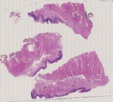 vignette Lame virtuelle : Œsophage : Cas n°5 - tumeur bénigne - endobrachyœsophage avec métaplasie intestinale