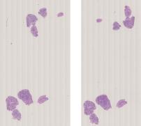 vignette Lame virtuelle : Œsophage : Cas n°3 - tumeur bénigne - endobrachyœsophage avec metaplasie intestinale et dysplasie de bas grade
