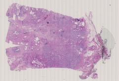 vignette Lame virtuelle : Prostate : Cas n°2 - tumeur maligne - adénocarcinome prostatique