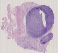 vignette Lame virtuelle : Testicule : Cas n°1 -tumeur Maligne - seminome