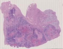 vignette Lame virtuelle : Testicule : Cas n°2 -tumeur Maligne - tumeur germinale