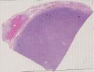 vignette Lame virtuelle : Testicule : Cas n°3 -tumeur Maligne - tumeur non germinale
