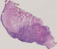 vignette Lame virtuelle : Langue : Cas n°1 - tumeur maligne - carcinome épidermoïde (CE) bien différencié kératinisant