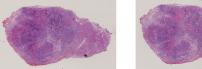 vignette Lame virtuelle : Thyroïde : Cas n°1 -tumeur Maligne - adénocarcinome papillaire