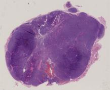 vignette Lame virtuelle : Thyroïde : Cas n°2 -tumeur Maligne - adénocarcinome vésiculaire