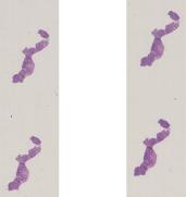 vignette Lame virtuelle : Thyroïde : Cas n°3 -tumeur Maligne - carcinome anaplasique